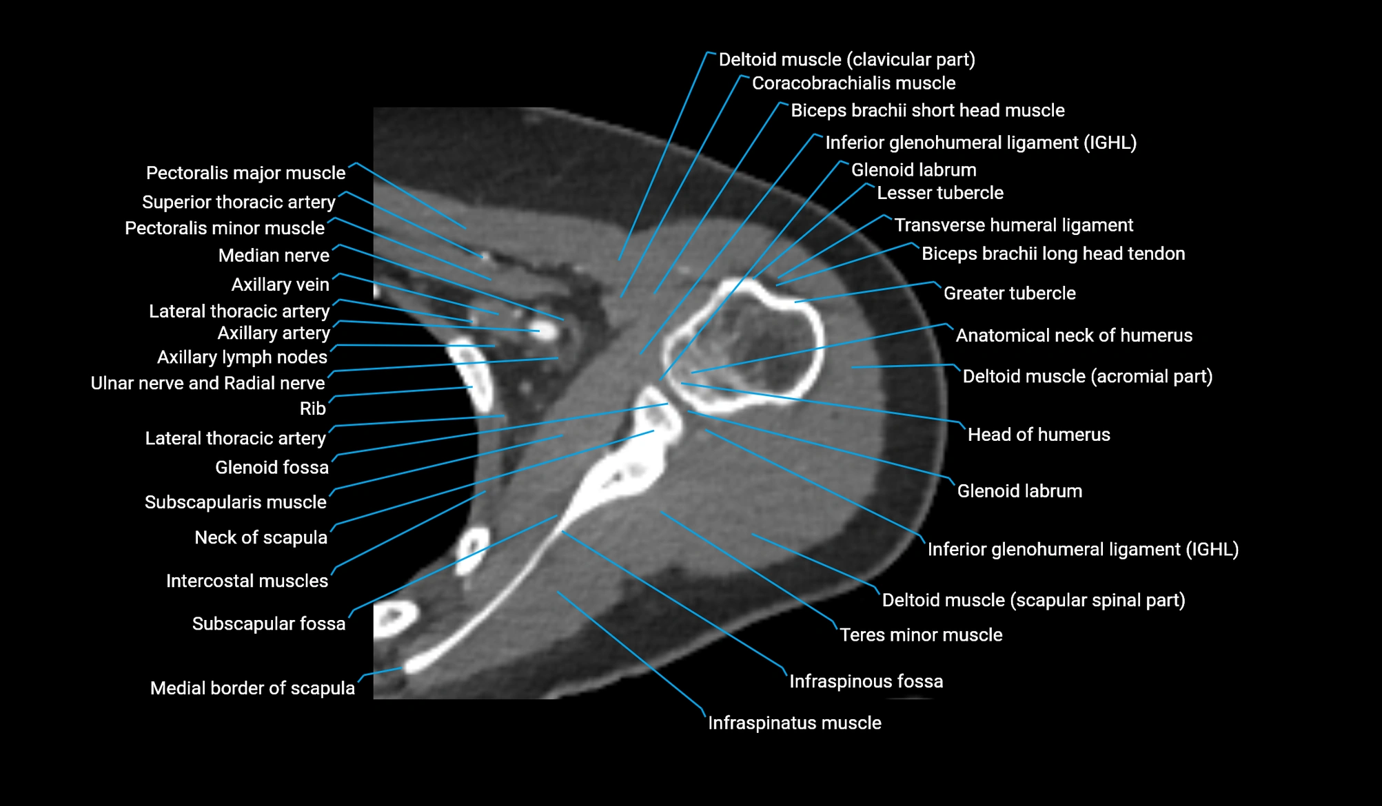 CT upper arm axial  cross sectional anatomy labelled radiology image -00108.webp
